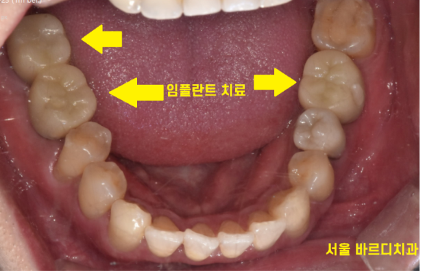 강일동 치과 잇몸뼈 녹음 발치 후 임플란트로 해결했습니다. 관련 이미지 9