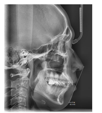 상일동 어린이 교정 성인 교정과 다르기에 놓치지 말아야합니다! 관련 이미지 3