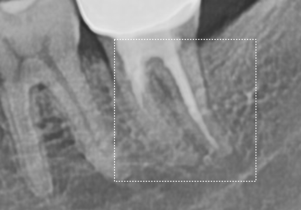 강동구 임플란트 기간, 사람마다 왜 다를까? 즉시식립과 지연식립의 결정적 차이 관련 이미지 4