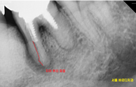 고덕역 치과 치아뿌리 파절 부러짐 있을 때 임플란트로 대체해야죠 관련 이미지 3