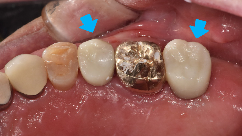 서울바르디치과 뿌리 끝 염증 심한 치아를 네비게이션 임플란트 #6 관련 이미지 18