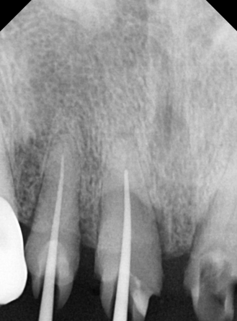앞니 음식물 끼임, 왜 젊을 때보다 더 자주 발생하는 걸까요? 까맣게 변한 앞니 치료 사례 관련 이미지 11