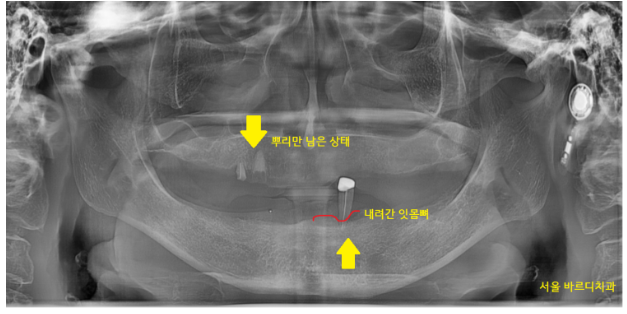 임플란트 틀니 치아가 없을 때 하남미사치과에서 해결하세요. 관련 이미지 3