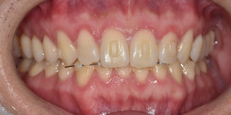 꼈다 뺐다 하는 교정 철사 붙이는건 옛말! 관련 이미지 5