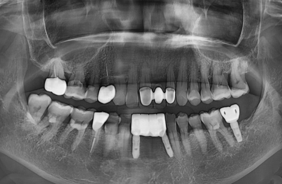솟구치는 앞니, 흔들리는 치아가 보내는 관련 이미지 14