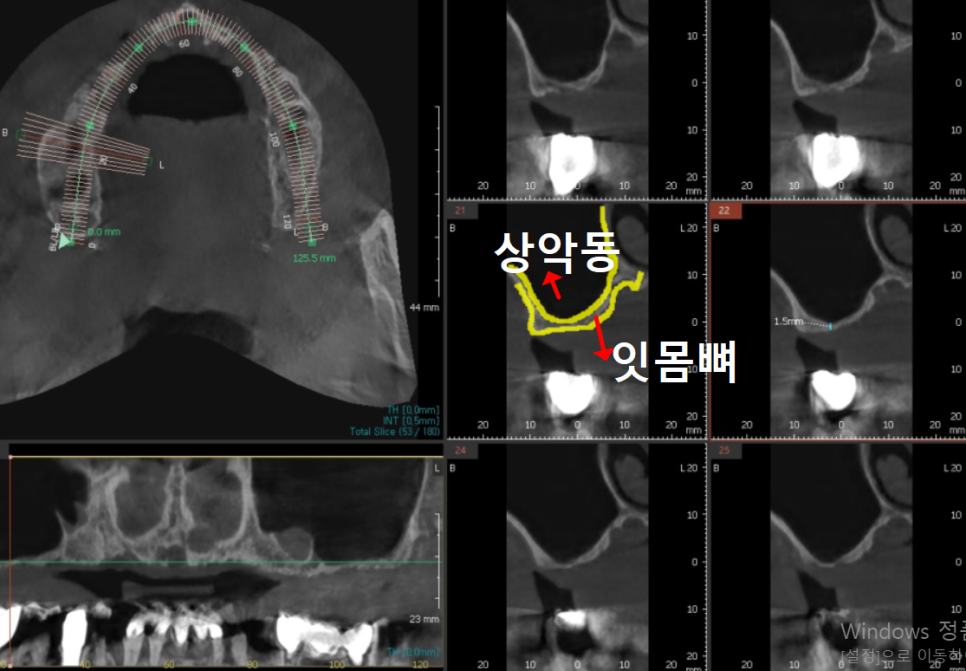 얇은 잇몸뼈, 임플란트 거부 당했다면? 상악동거상술로 해결할 수 있습니다. 관련 이미지 6