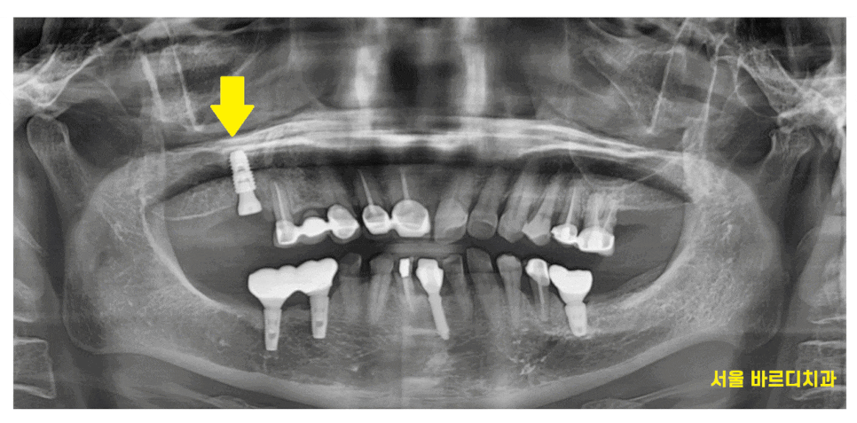 암사동 치과 골다공증 치료 중 임플란트 가능한가요?? 관련 이미지 1