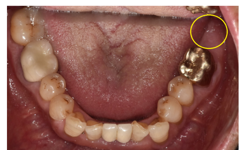 상일동 임플란트 수술 과정 시작부터 끝까지 따라와주세요! 관련 이미지 2