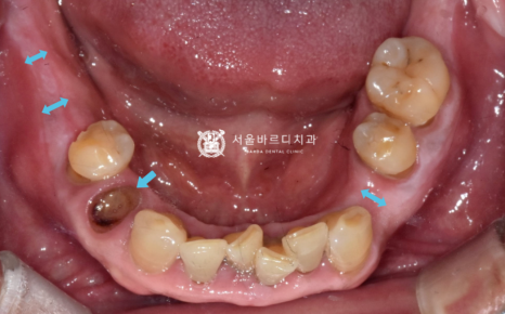 고덕동치과 서울바르디치과 무절개 네비게이션 임플란트 치료증례 #1 관련 이미지 6