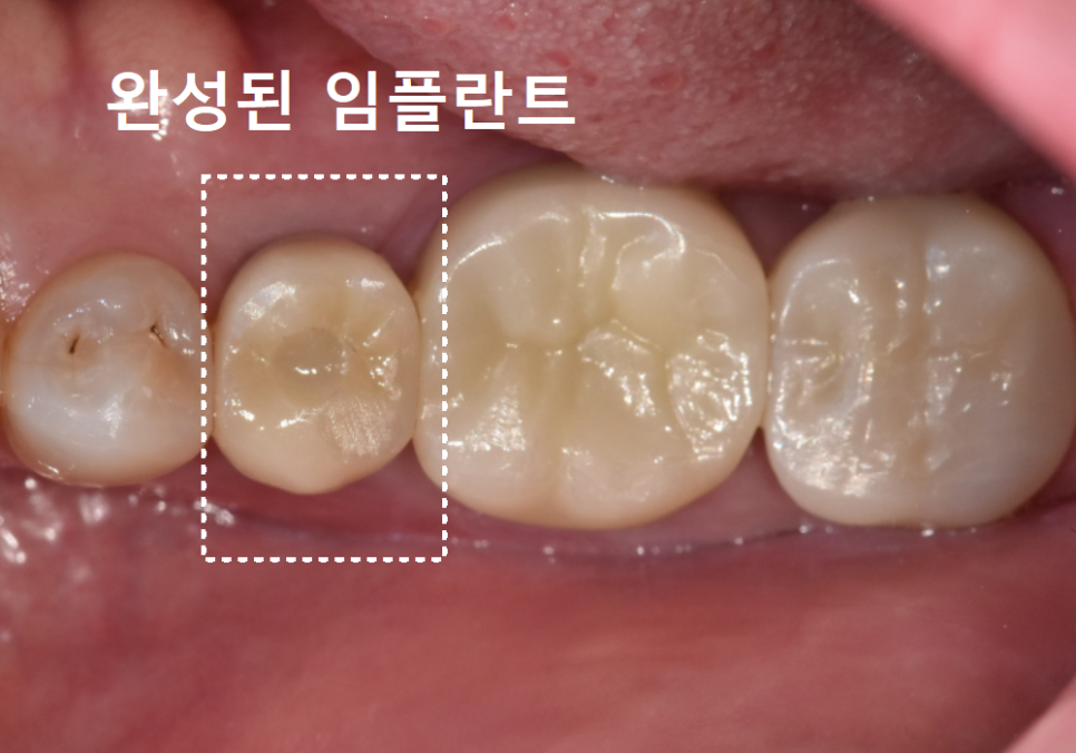 아말감 파절, 조금 깨졌을 뿐인데, 2차 충치로 치아 절반이 깨진 사연 관련 이미지 11