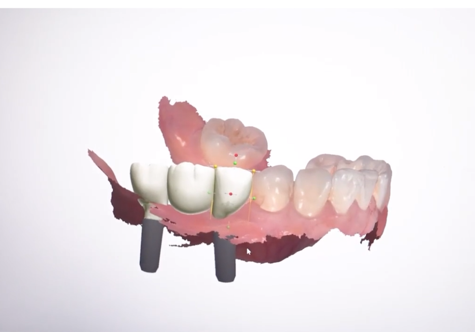 고덕동 심미 보철, 삐뚤어진 앞니, 교정 없이 바로잡은 비결 관련 이미지 15