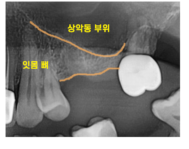 상일동 임플란트 상악동 거상술을 동반한 수술 증례 관련 이미지 2