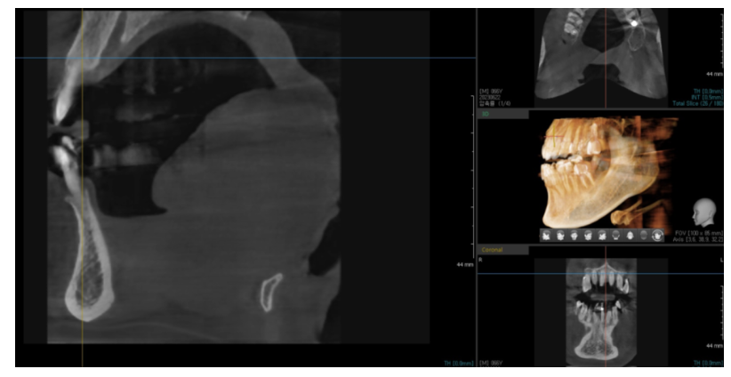 상일동 임플란트 수술 과정 시작부터 끝까지 따라와주세요! 관련 이미지 3