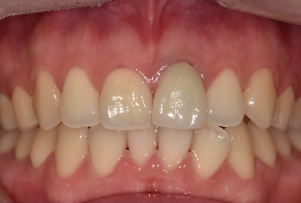 명일동 치과, 잇몸이 검게 변했다면? 앞니 변색 원인은 바로 관련 이미지 8