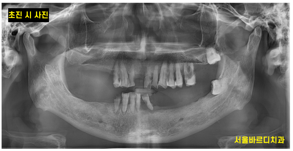 외국인 치과 진료 하악 전체 임플란트 7개 심어 12개 치아 만들기 관련 이미지 2