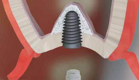If you lightly brush your backmost molar because the toothbrush can’t reach it, this is what happens. image 14