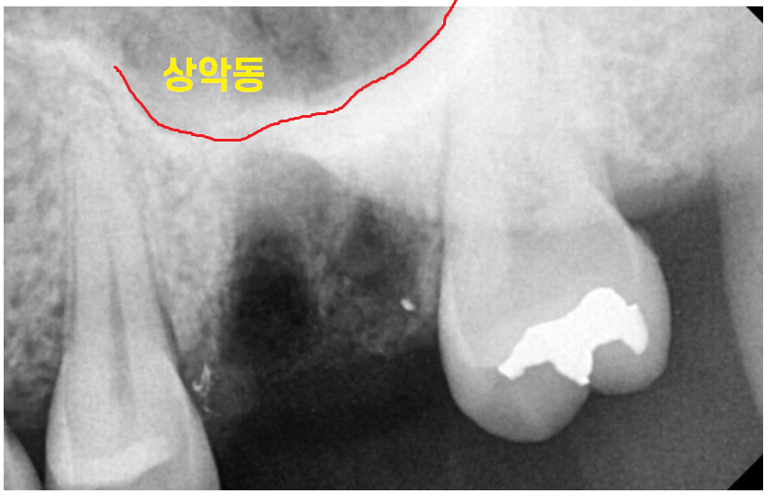 디지털 임플란트 체계적인 수술이 가능한 서울바르디치과입니다. 관련 이미지 7