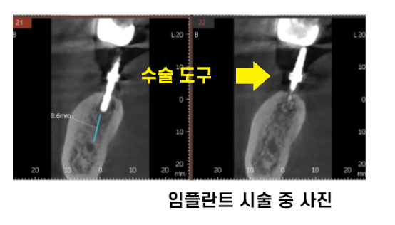 하남시청치과 내비게이션 임플란트 왜 좋다는거죠? 관련 이미지 6