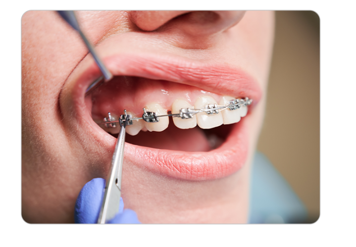 강동구 치아교정 아이들 방학 때 시작하면 좋은 이유 관련 이미지 2