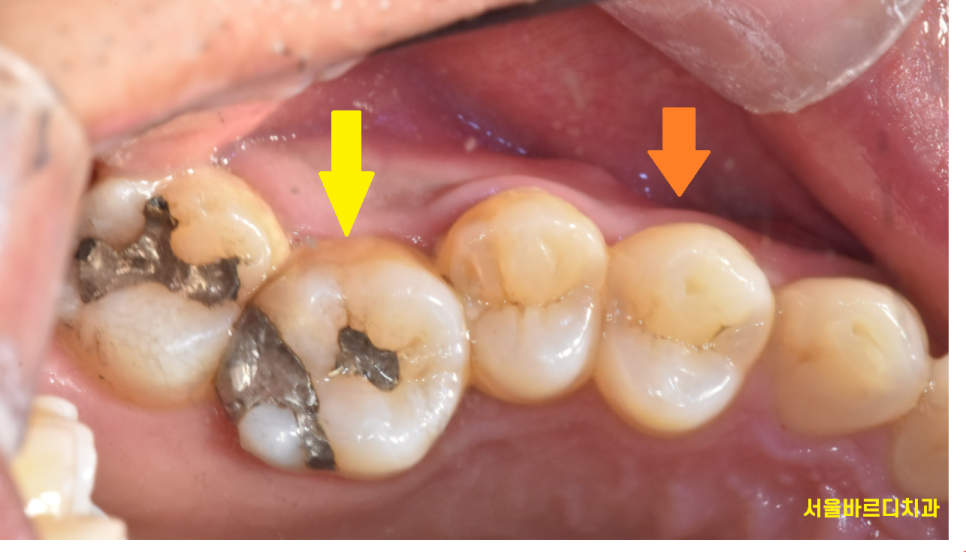 길동 치과 검은 점 충치 검정색이라고 다 치료할 필요는 읎다! 관련 이미지 3