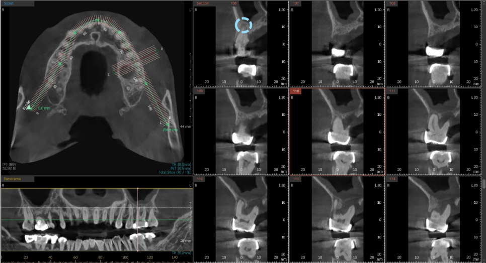 고덕동치과 서울바르디치과 무절개 네비게이션 임플란트 치료증례 #2 관련 이미지 6