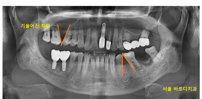고덕역 근처 치과 브릿지와 임플란트 고민 중이신 분들 클릭하세요 관련 이미지 3
