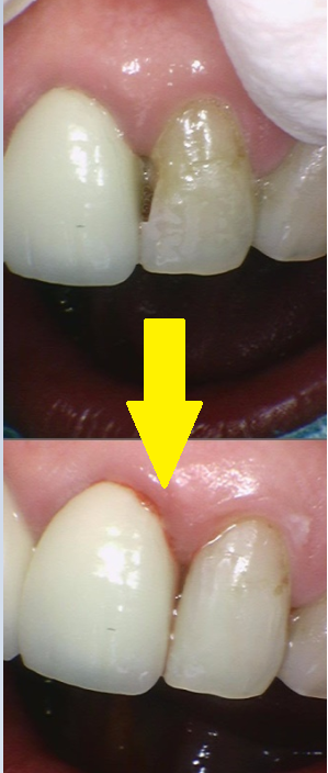 치아 땜질 다 떼울 수는 없지만..강동구 치과에서는 이렇게 합니다. 관련 이미지 4