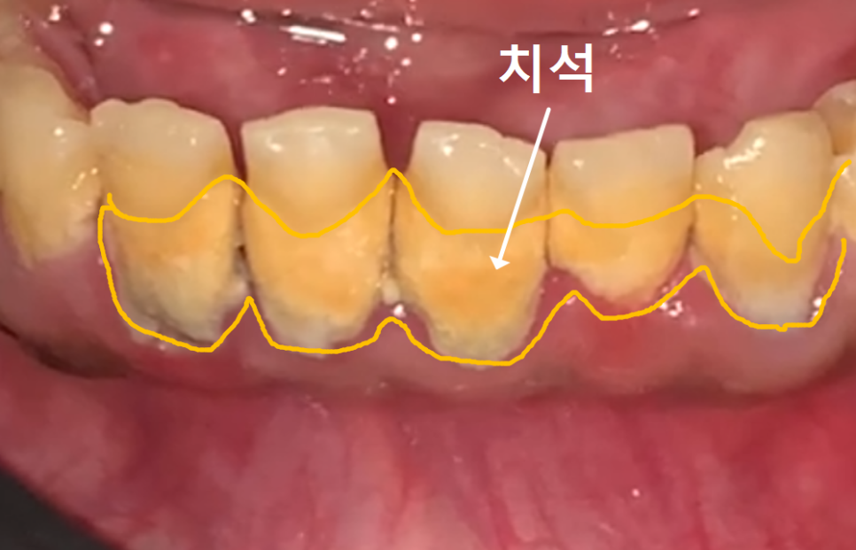 스케일링했더니 잇몸 구멍, 치아 사이 구멍이 생겼어요. 스케일링에 관한 오해 3가지 관련 이미지 1