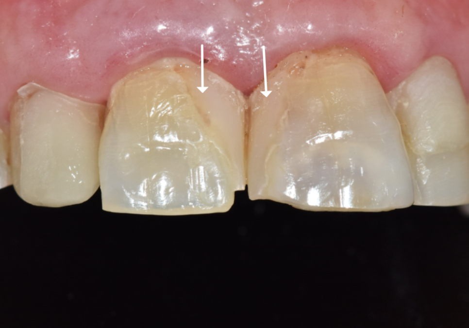 고덕역 치과 반점치 얼룩덜룩한 치아, 치료 실패 줄이는 5가지 기준 관련 이미지 2