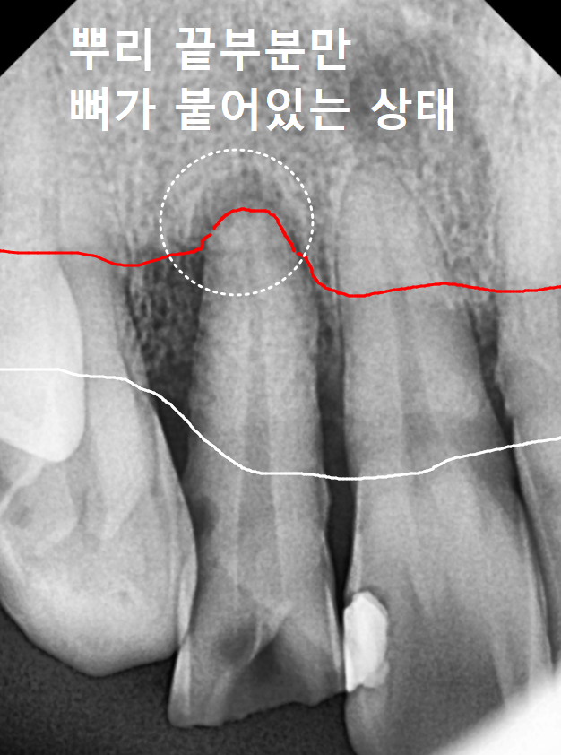 강동구 앞니 충치, 누구는 레진이고 누구는 임플란트인 관련 이미지 4