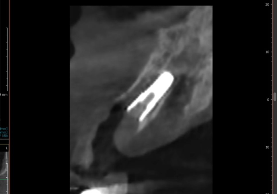 앞니 길어짐, 위 앞니가 점점 내려온다면? 관련 이미지 12