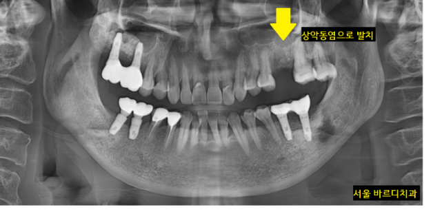 미사역 임플란트 상악동염으로 치아를 발치한 사연 관련 이미지 7