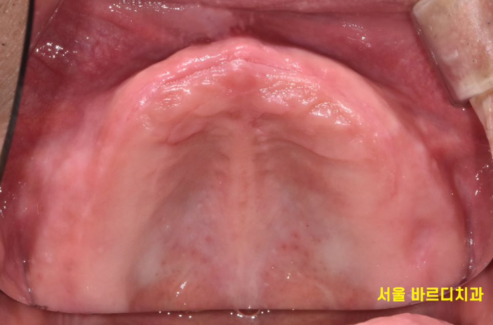상일동 치과 임플란트 국가 지원 혜택 싹 정리했습니다. 관련 이미지 3