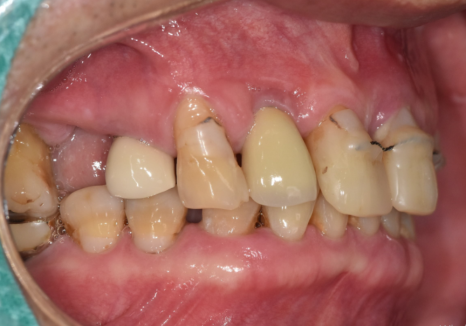 앞니 흔들림, 임플란트 치아보험 감액 기간 넘기려다 더 큰 손해 봅니다. 관련 이미지 3