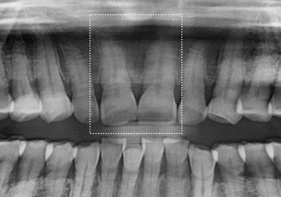대문니 파절, 앞니에 금이 쩍 갈라졌다면? 딱딱한 음식을 조심해야 하는 이유 관련 이미지 10