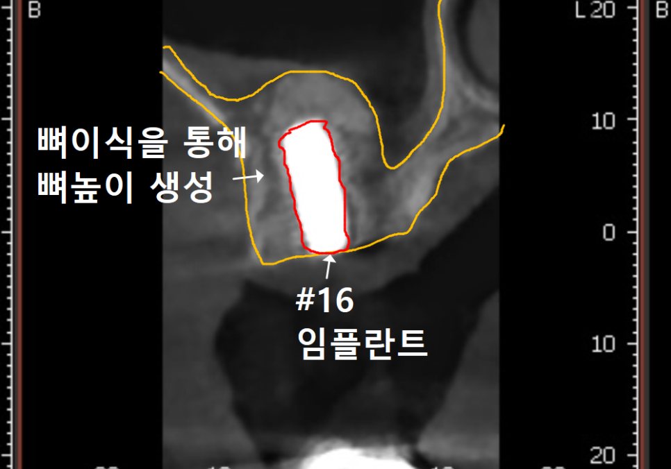 상악동 거상술 부작용 걱정되시나요? 재수술 없는 뼈이식의 정석 공개 관련 이미지 11