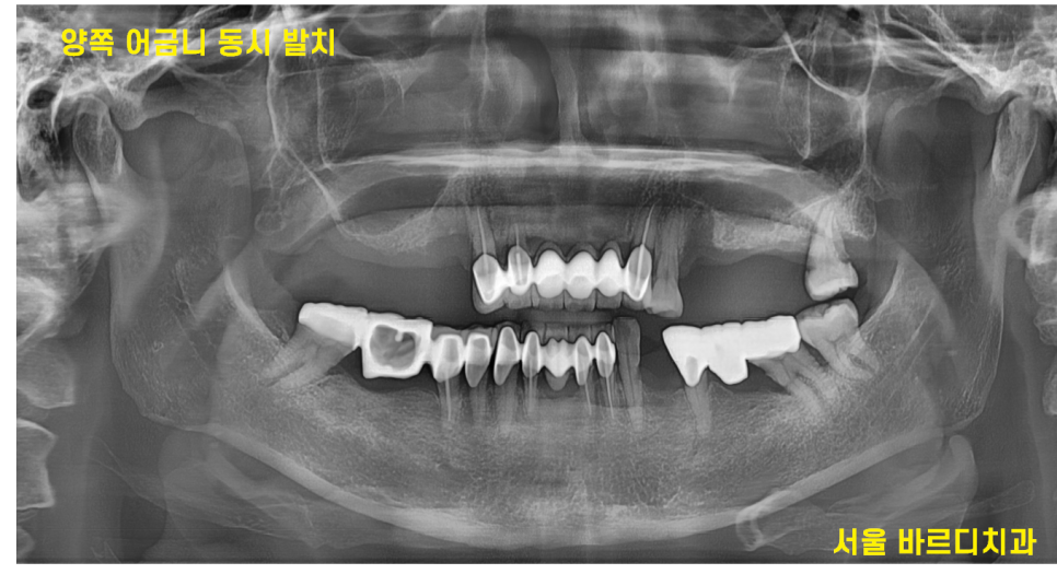 고덕동 치과 뼈이식 동반 양쪽 어금니 임플란트 동시 진행 관련 이미지 4