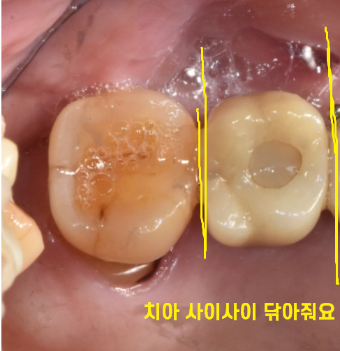 명일동 치과 임플란트 주의사항 끝날 때까지 끝난게 아니다 관련 이미지 5