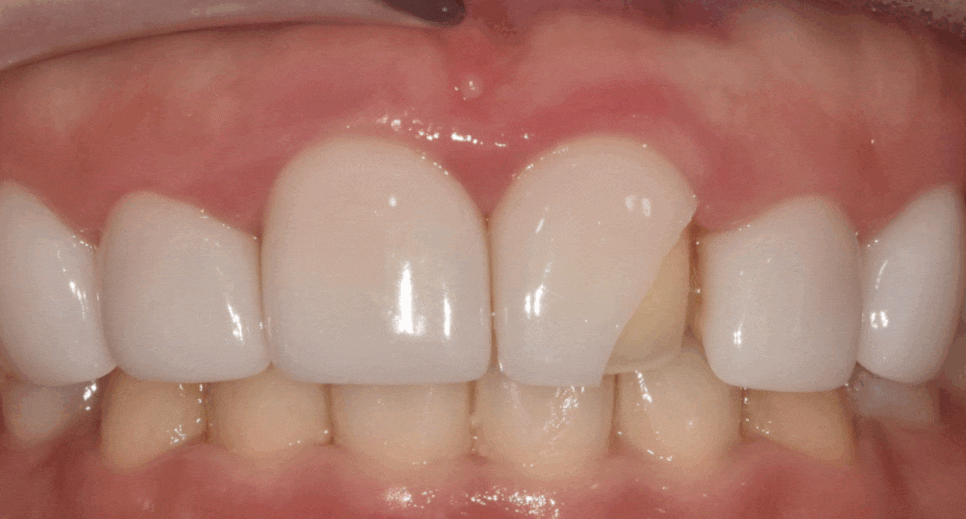 라미네이트 깨짐 원인 TOP 3, <대표원장>이 직접 알려드립니다 관련 이미지 7