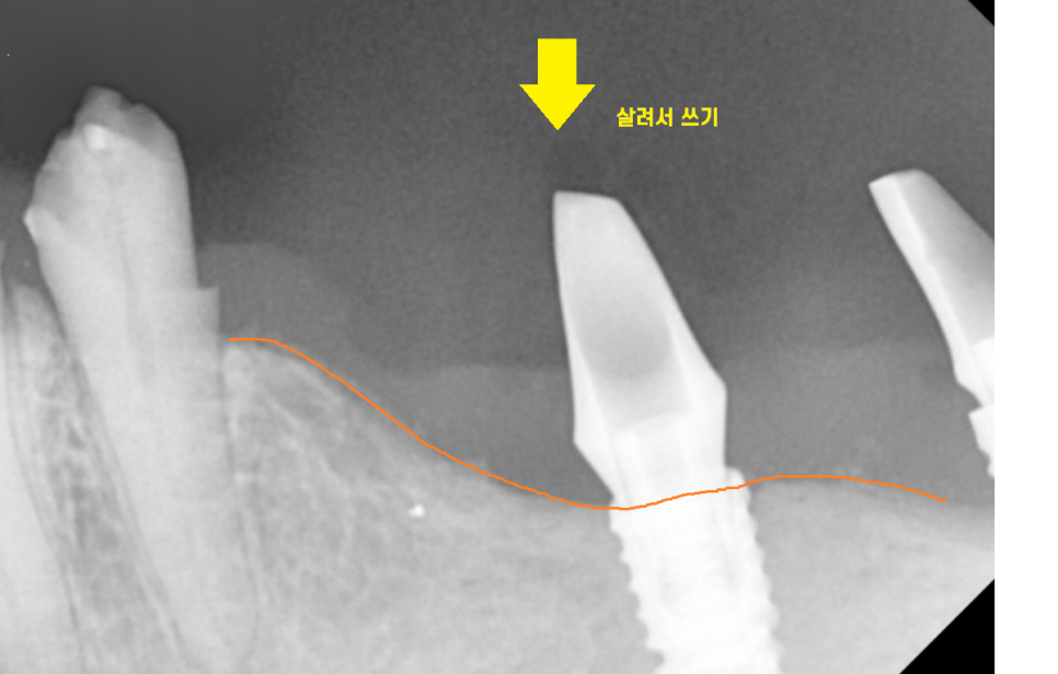 고덕동치과 이가 다 부서졌을 때 임플란트 치료했습니다. 관련 이미지 5