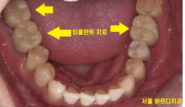 강일동 치과 잇몸뼈 녹음 발치 후 임플란트로 해결했습니다. 관련 이미지 1