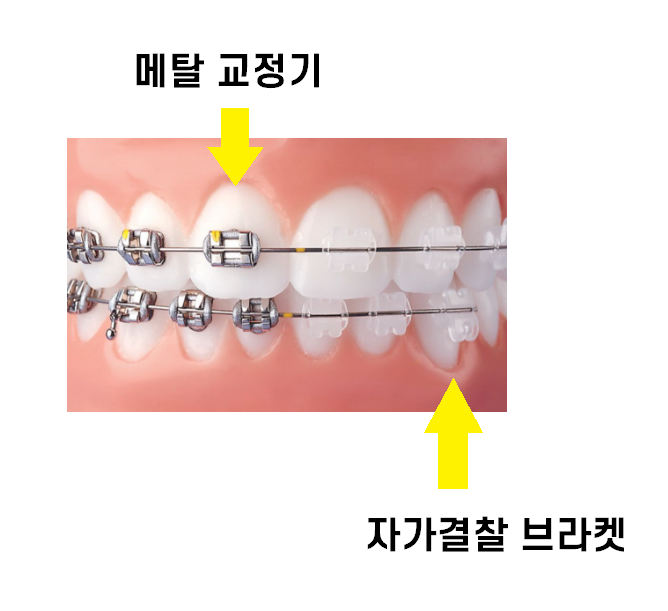 치아 교정기 종류 결정장애 환자분들을 위한 친절한 설명서 관련 이미지 3