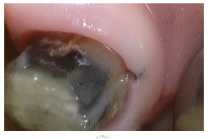 천호동 치과 과잉 진료를 피하는 방법 대공개 관련 이미지 11