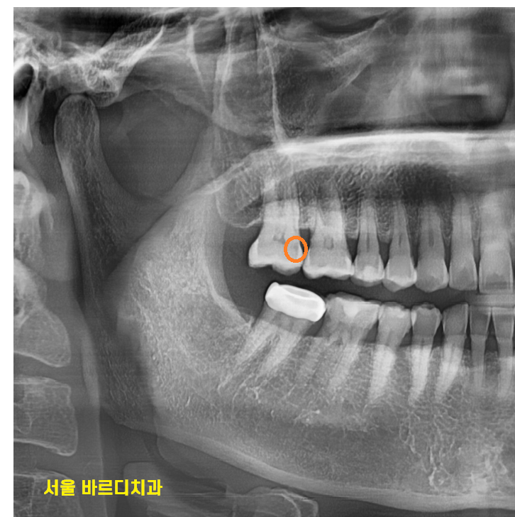 치실 안쓰면 이렇게 됩니다!!  치아 사이 충치 인레이 치료 관련 이미지 3