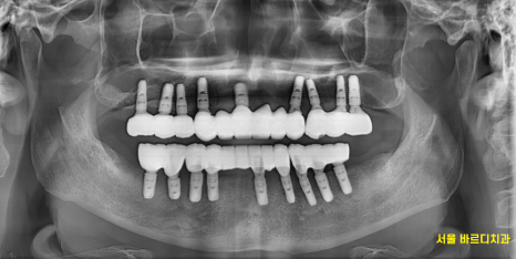 고덕역  치과 틀니쓰다 위아래 전악 임플란트 재건했습니다. 관련 이미지 14