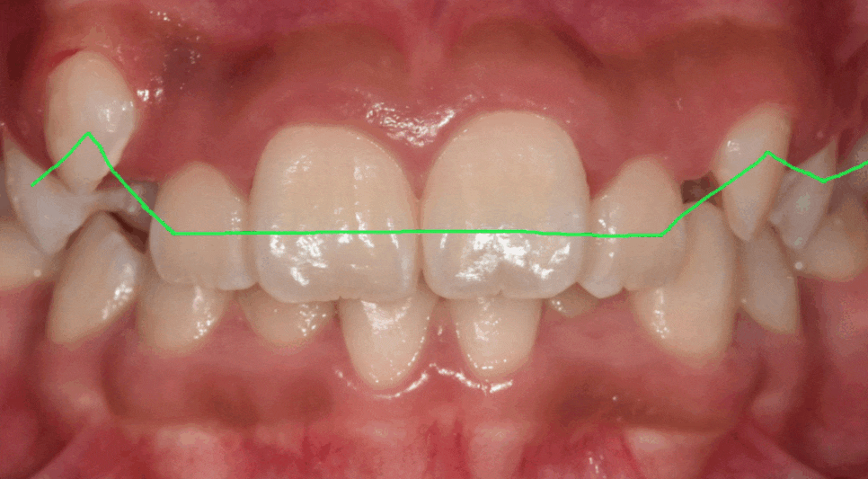 How to Correct a Canine Crowding Malocclusion: Extractions Are Necessary to Address Lip Protrusion image 1