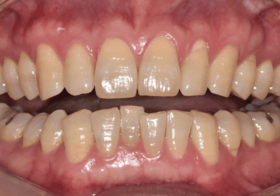 명일역 앞니 부분 교정, 치아 하나만 삐뚤어져 보인다면? 굳이 전체 교정할 필요 없습니다. 관련 이미지 12