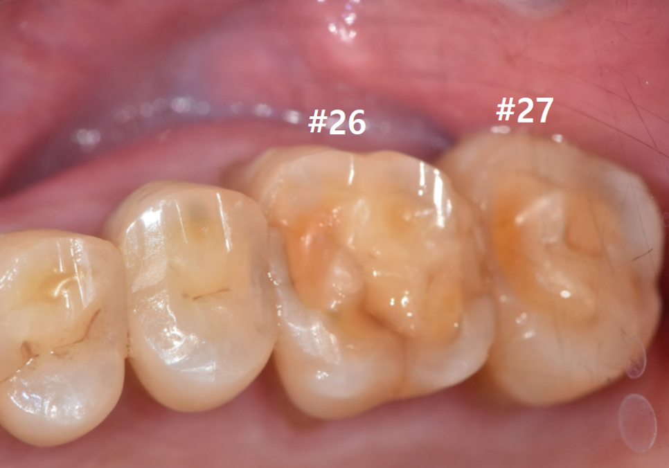 어금니 금 감, 치아 살릴 수 있는 기준은 바로 관련 이미지 4