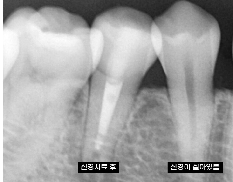 치아 멍 까맣게 변했어요 변색되고 괴사되었을 때 대처법 공개 관련 이미지 3