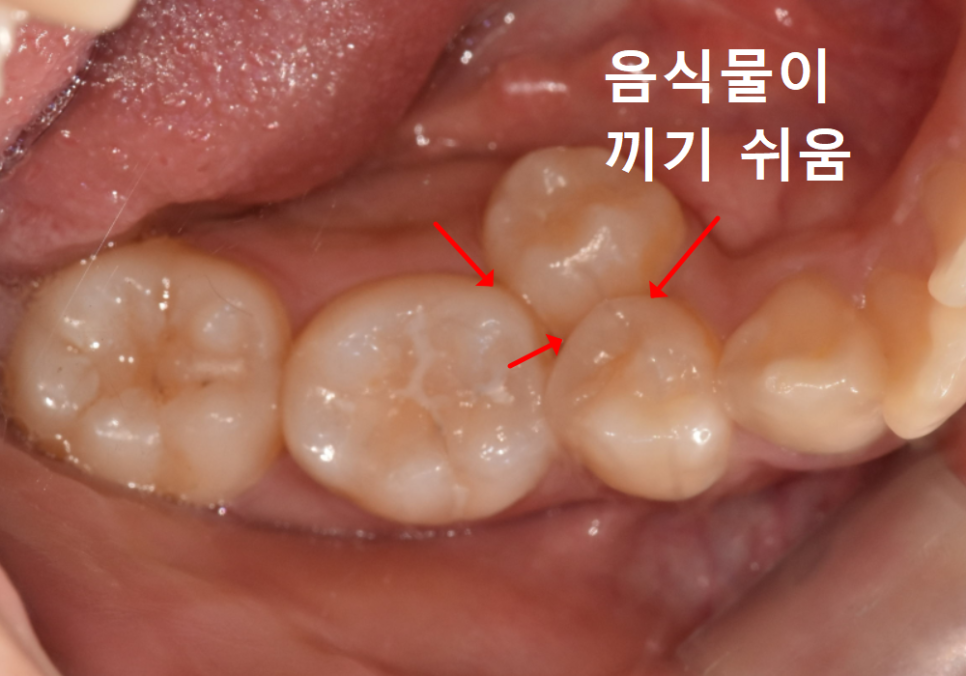 어금니 덧니 때문에 임플란트 해야 한다고요? 방치하면 안 되는 이유 관련 이미지 1